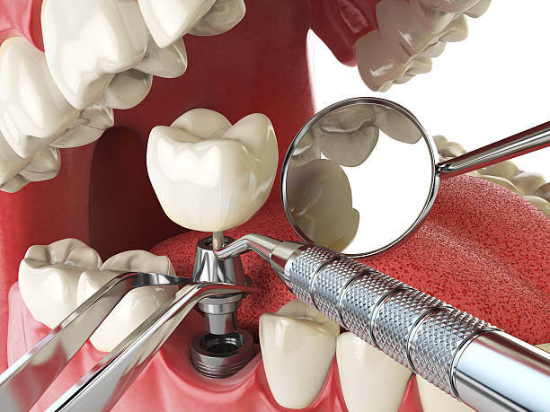 Best Emergency Tooth Extraction in Fairmount, CO